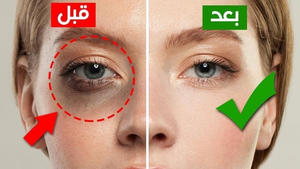الهالات السوداء: الأسباب وطرق العلاج
