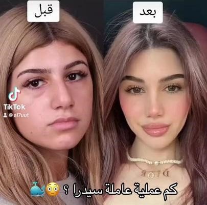 سيدرا بيوتي قبل وبعد عمليات التجميل: تحوّل جمالي ملهم